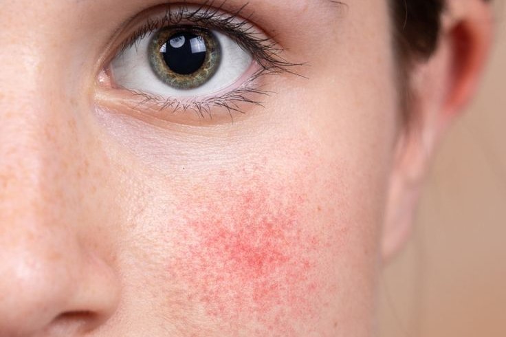Rekomendasi Moisturizer kulit sensitif